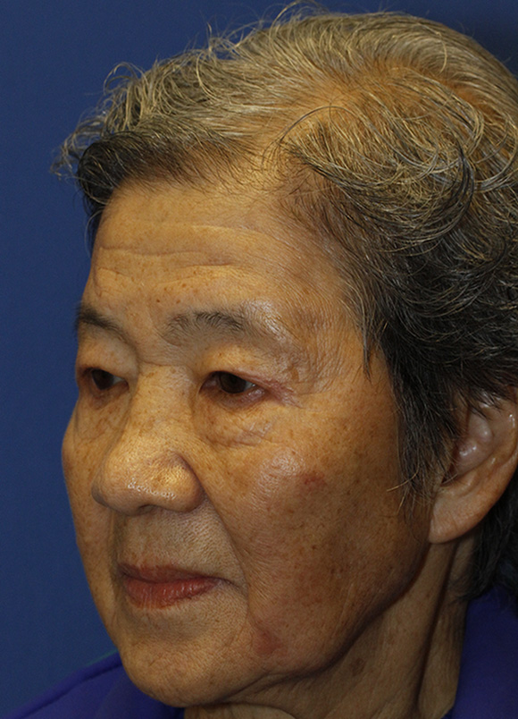 After Asian Blepharoplasty Oblique