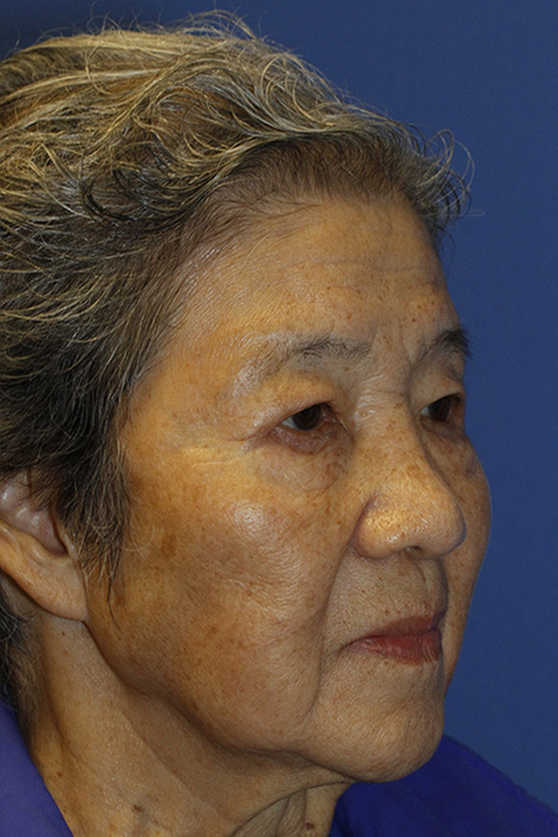 After Asian Blepharoplasty Oblique