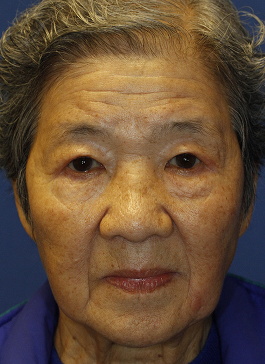 After Asian Blepharoplasty Frontal