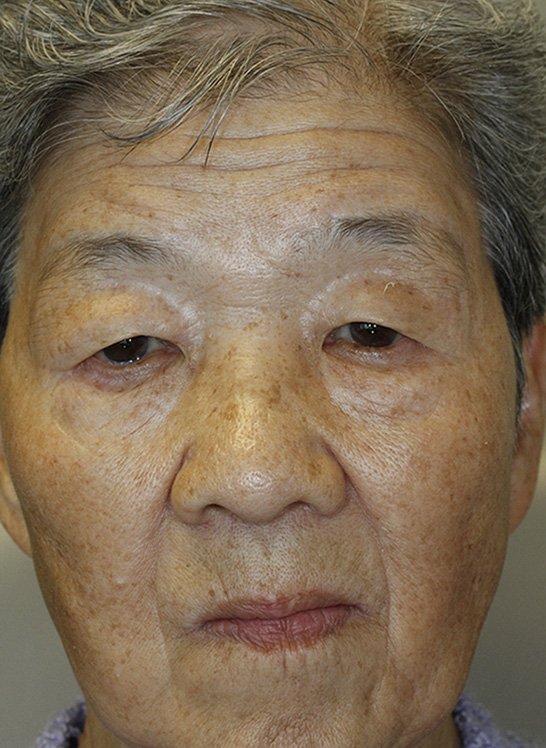 Before Asian Blepharoplasty Frontal