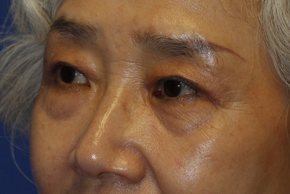 Asian Blepharoplasty After Left Oblique