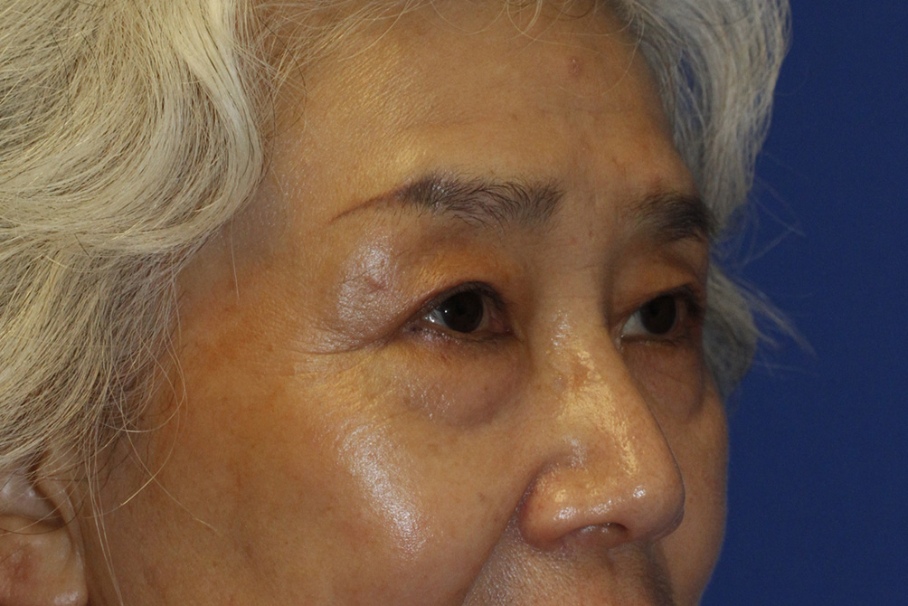 Asian Blepharoplasty After Right Oblique