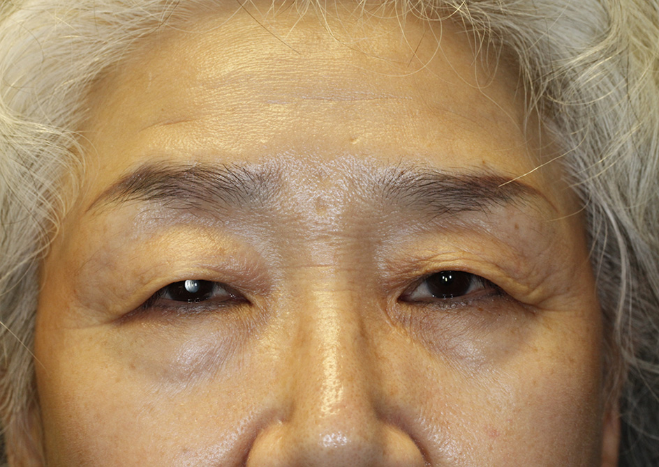 Asian Blepharoplasty Frontal Before