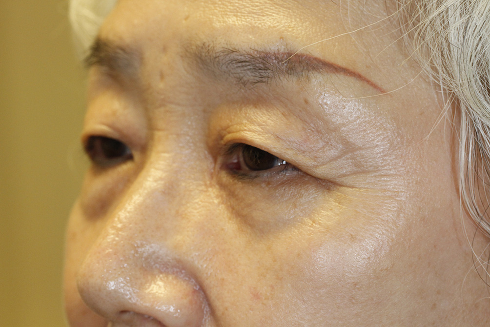 Asian Blepharoplasty Left Oblique Before