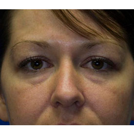 Before Blepharoplasty Photo detail