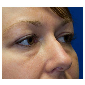 Before Blepharoplasty Photo Oblique