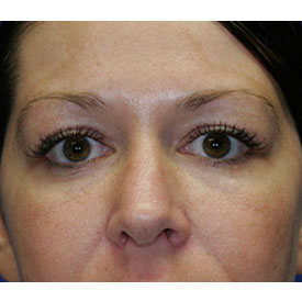 After Blepharoplasty Photo detail