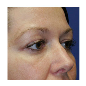 After Blepharoplasty Photo Oblique