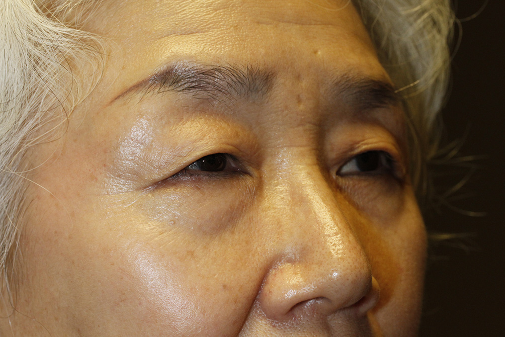 Asian Blepharoplasty Right Oblique Before