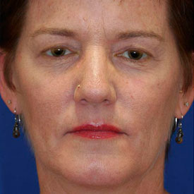 Before Blepharoplasty Photo Frontal