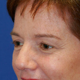 Before Blepharoplasty Photo Oblique