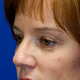 After Blepharoplasty Photo Oblique