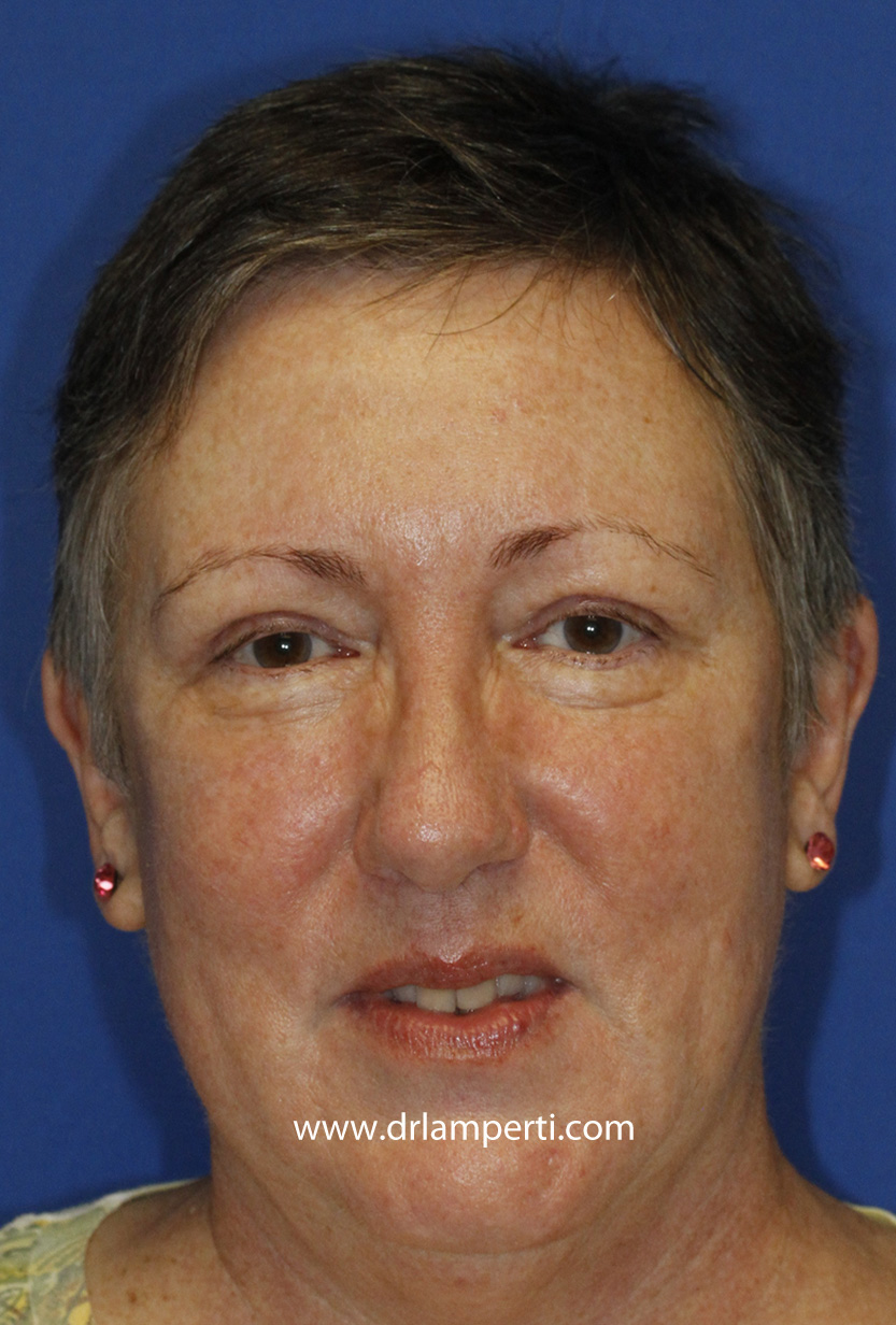 Blepharoplasty Frontal After