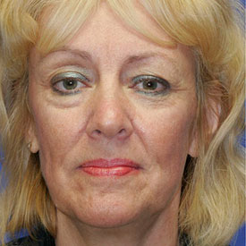 Before Blepharoplasty Photo Frontal