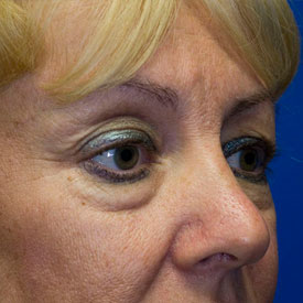 Before Blepharoplasty Photo Oblique