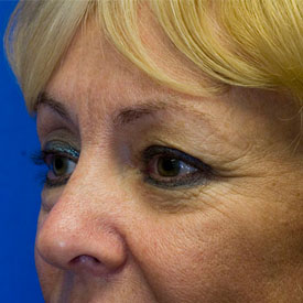 Before Blepharoplasty Photo Oblique