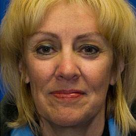 After Blepharoplasty Photo Frontal