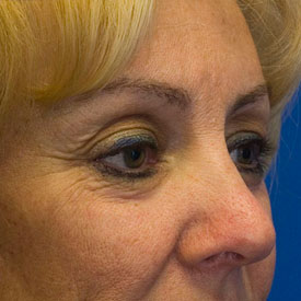 After Blepharoplasty Photo Oblique