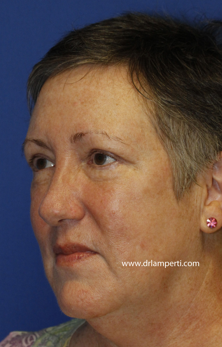 Blepharoplasty Left Oblique After