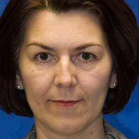 Before Blepharoplasty Photo Frontal