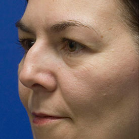 Before Blepharoplasty Photo Oblique