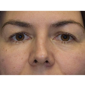 Before Blepharoplasty Photo detail