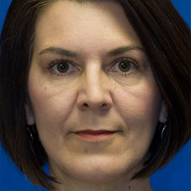 After Blepharoplasty Photo Frontal