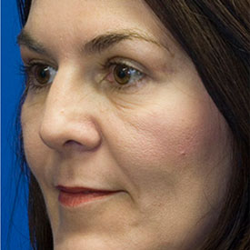 After Blepharoplasty Photo Oblique