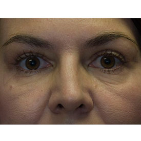 After Blepharoplasty Photo detail