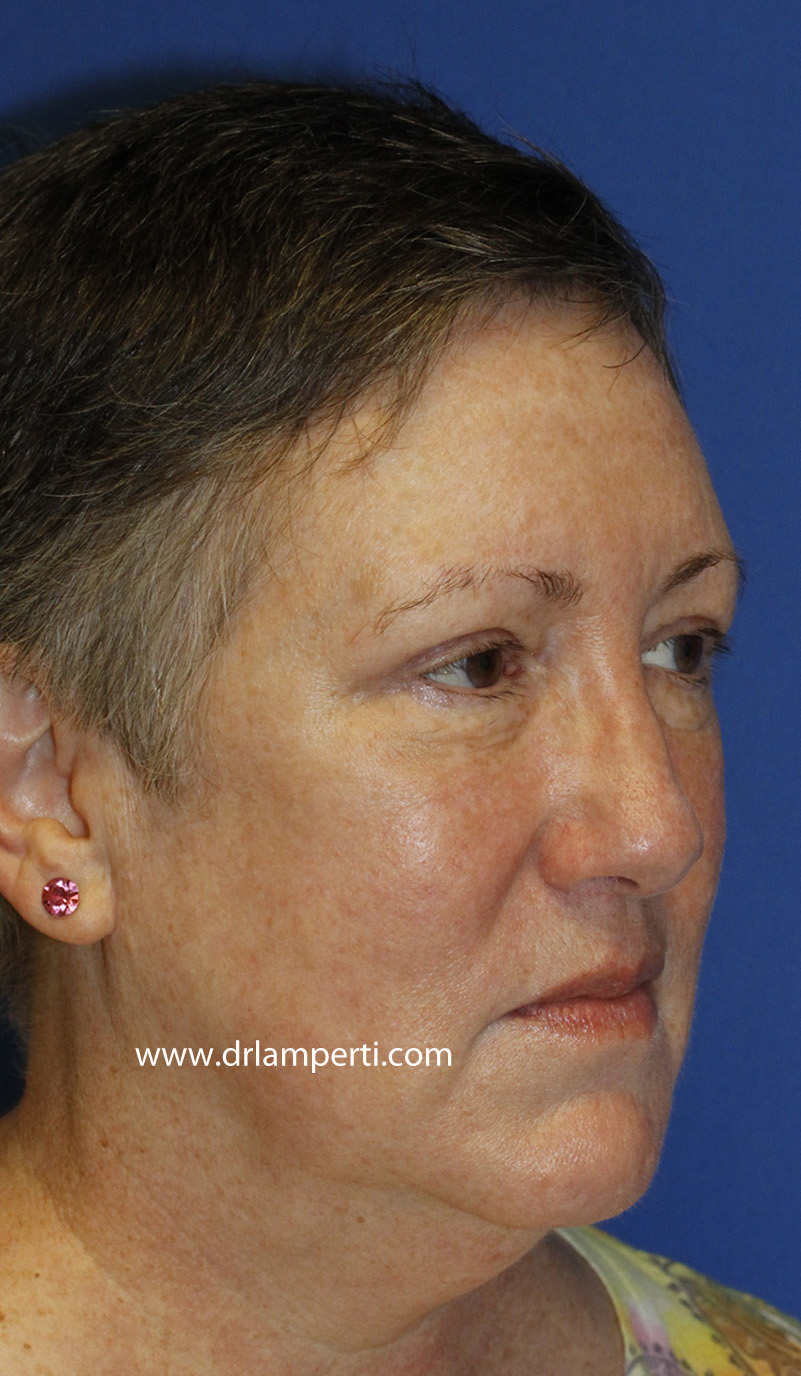 Blepharoplasty Right Oblique After