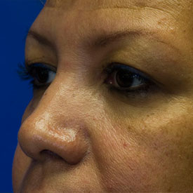 Before Blepharoplasty Photo Oblique