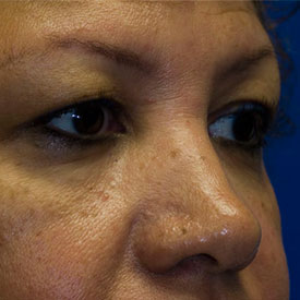 Before Blepharoplasty Photo Oblique