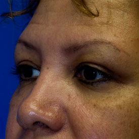 After Blepharoplasty Photo Oblique