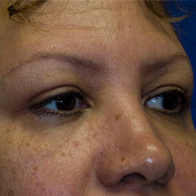 After Blepharoplasty Photo Oblique