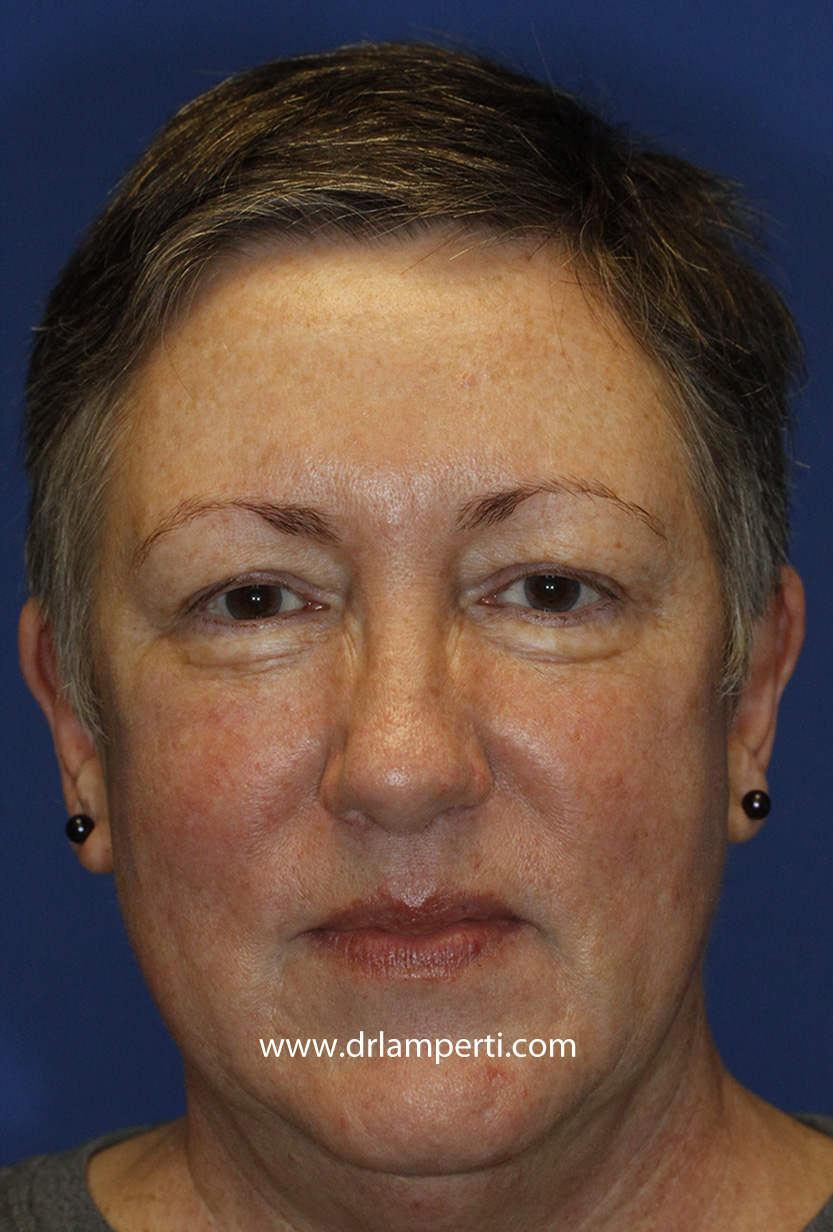 Blepharoplasty Frontal Before