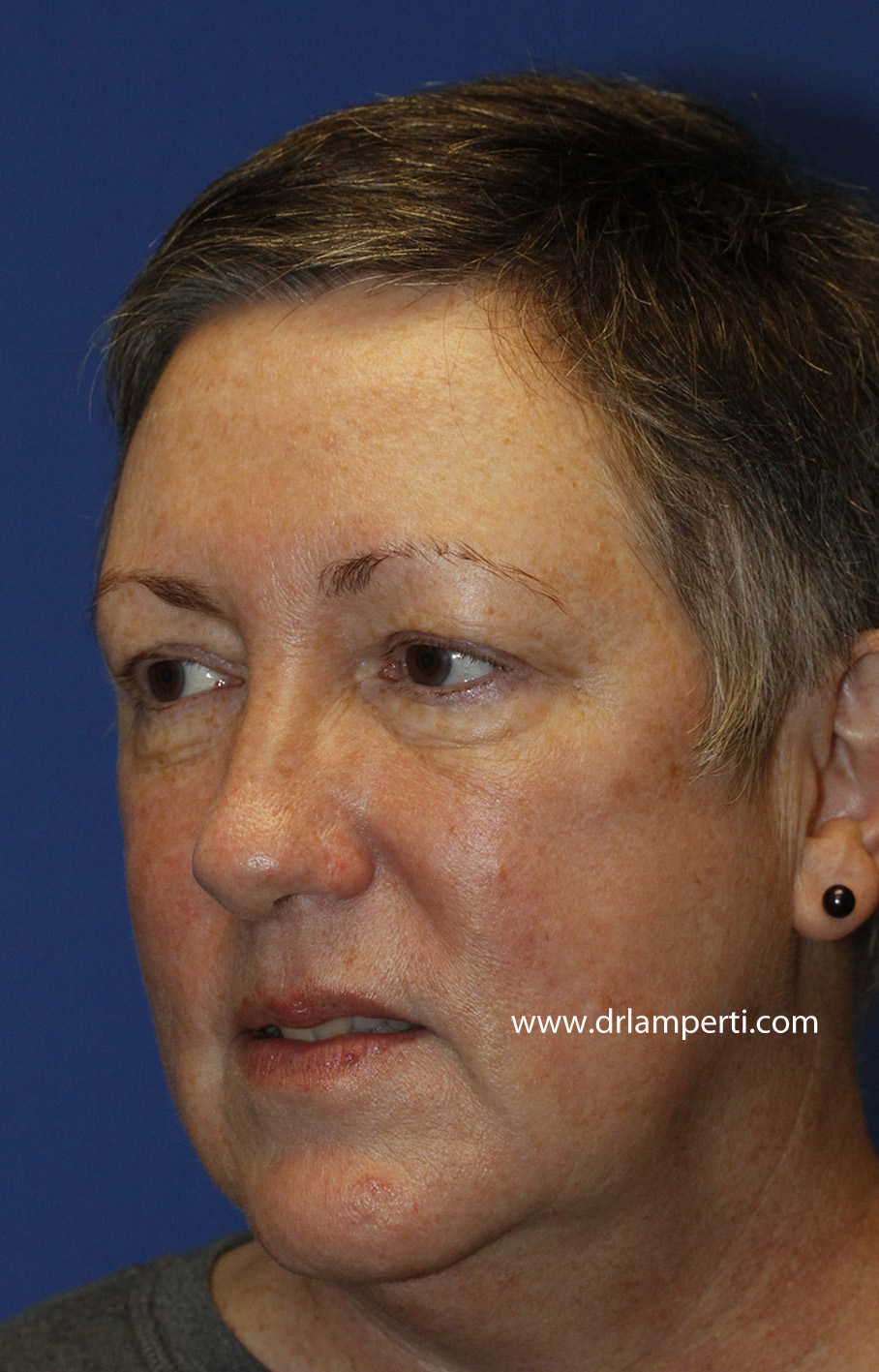 Blepharoplasty Left Oblique Before