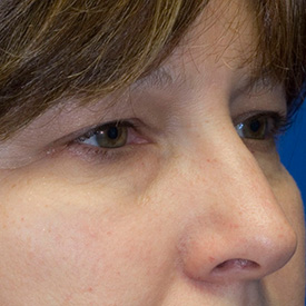 Before blepharoplasty photo