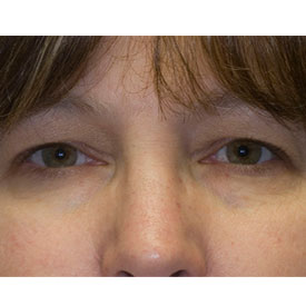 Before blepharoplasty photo