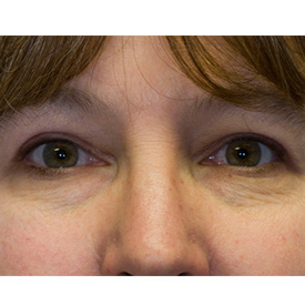 After blepharoplasty photo