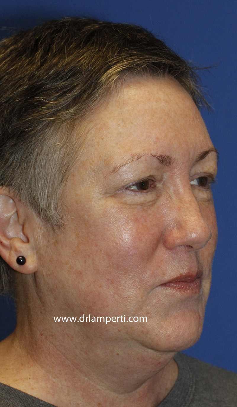 Blepharoplasty Right Oblique Before