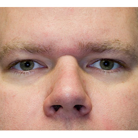 Before blepharoplasty photo