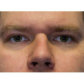 After blepharoplasty photo