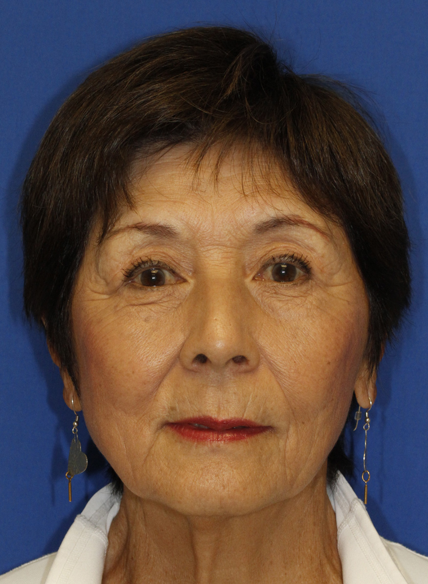 After Blepharoplasty Frontal