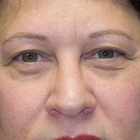 Before blepharoplasty photo