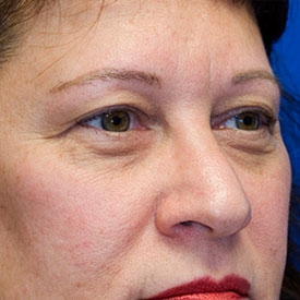 Before blepharoplasty photo