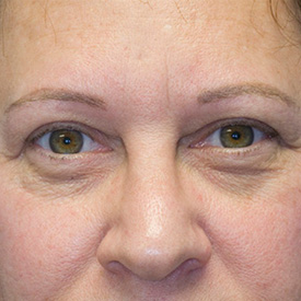 After blepharoplasty photo