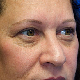 After blepharoplasty photo