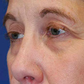 Before blepharoplasty photo