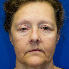 Before blepharoplasty photo