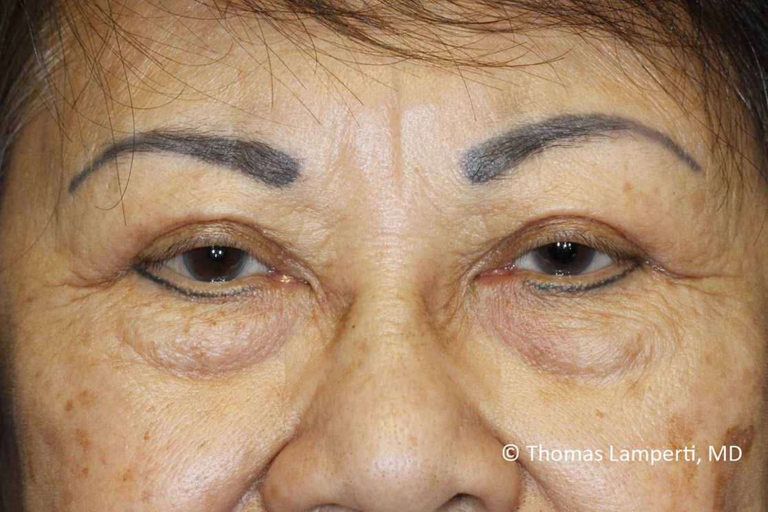 After Blepharoplasty Frontal Detail